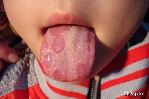 宝宝吃瓜枣舌苔有点黑,瓜枣摄入过多或需关注健康调整