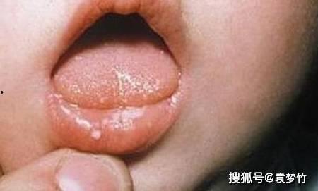 宝宝吃瓜枣舌苔有点黑,瓜枣摄入过多或需关注健康调整