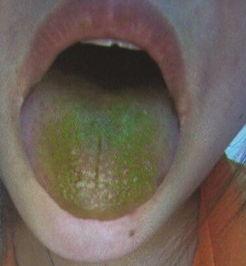 宝宝吃瓜枣舌苔有点黑,瓜枣摄入过多或需关注健康调整